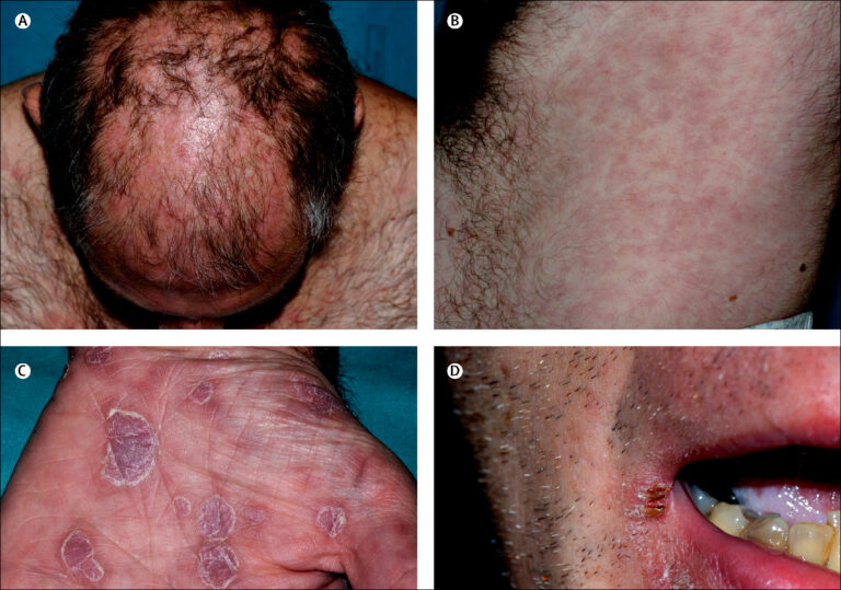 syphilis