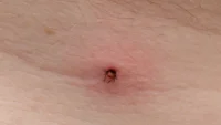 tick bite