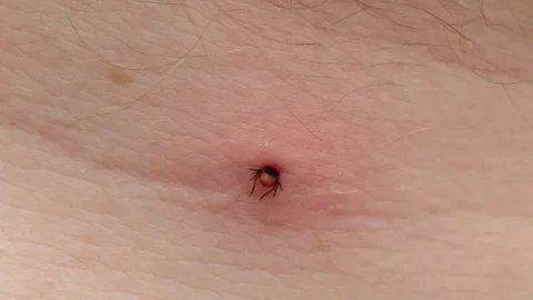 tick bite