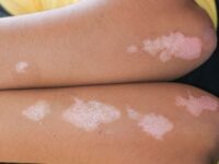white spots on skin